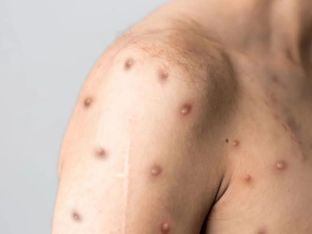 Bahia confirma dois casos de Mpox em 2026