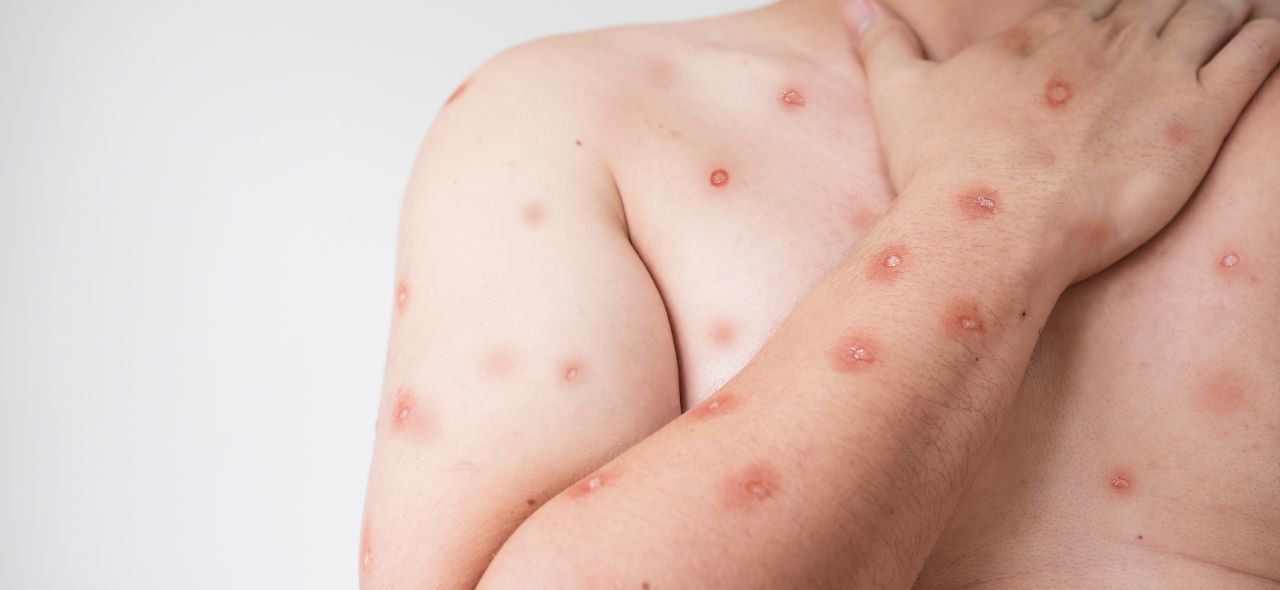 Casos de Mpox são confirmados no Brasil e cenário é monitorado em Sergipe