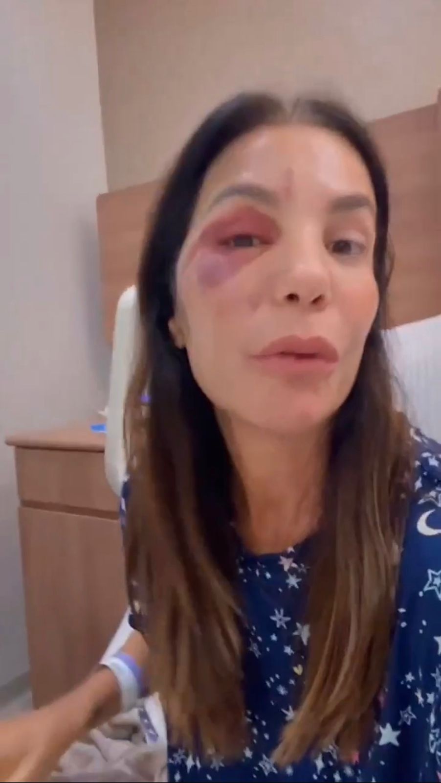 Ivete Sangalo passa por cirurgia no rosto após queda